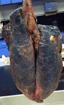 Smoker lung